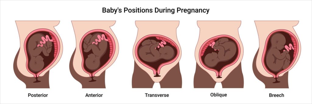 Can an Incorrect Position Affect Uterine Size in Pregnancy?